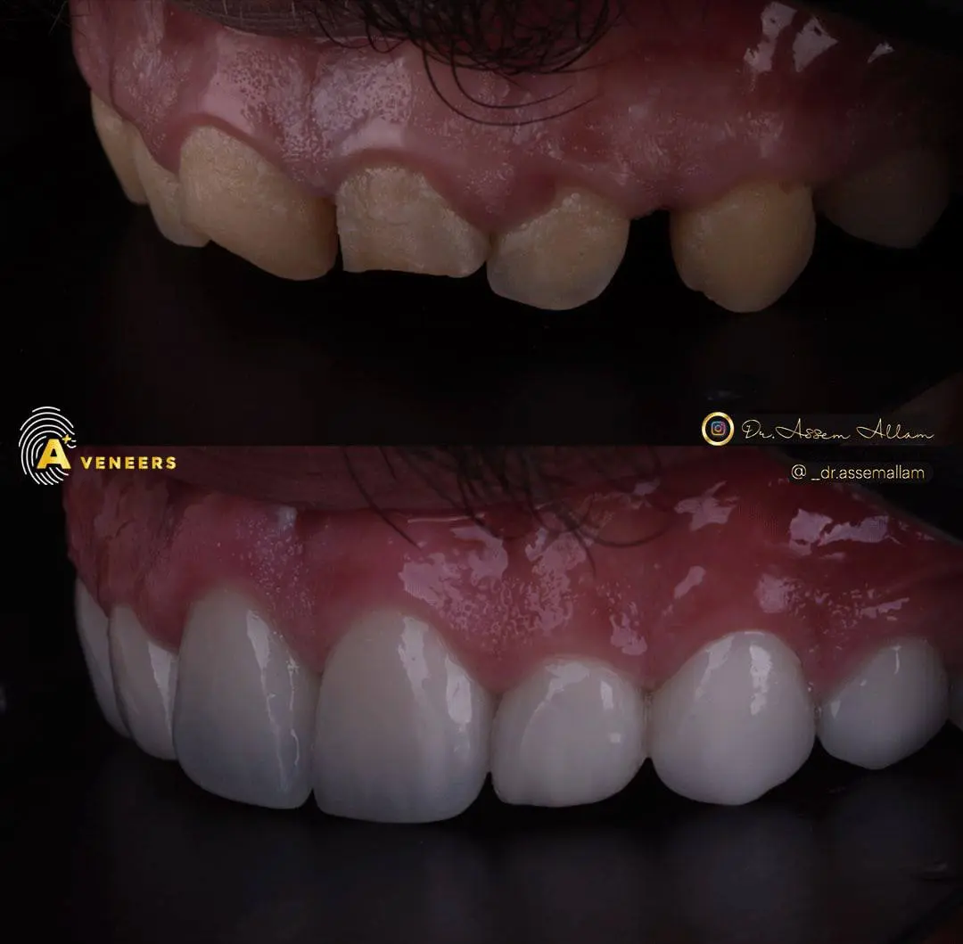 Mohamed J Intra Oral Before and After